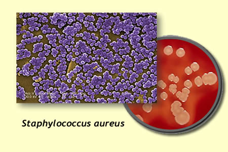 Staphylococcus Aureus and Disease - News Medical